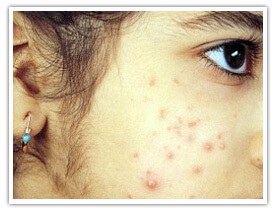 Acne and Pimples