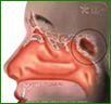 Sinusitis