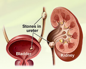 Renal Stone