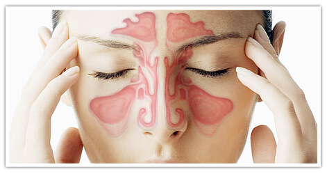 The Root Causes of Sinusitis