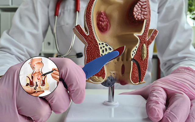 Doctor explaining piles and anal fistula using a rectal anatomy model during a proctology consultation